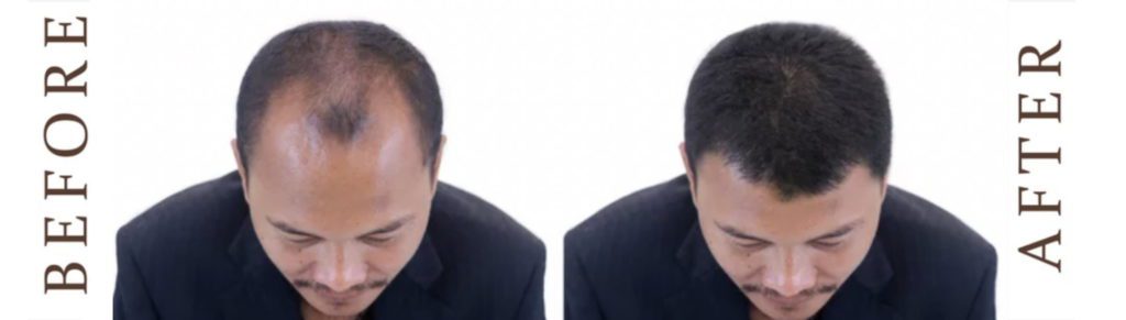 Before and after hair restoration