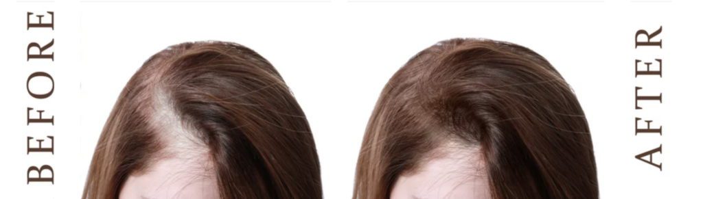 Before and after woman hair restoration